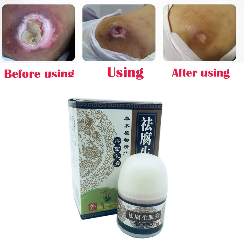 

Herbal removal rot myogenic cream bedsores paste treat pressure sores pressure ulcer festering wound healing