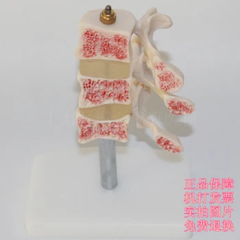 

Lesion spinal model Spine model Intervertebral disc model