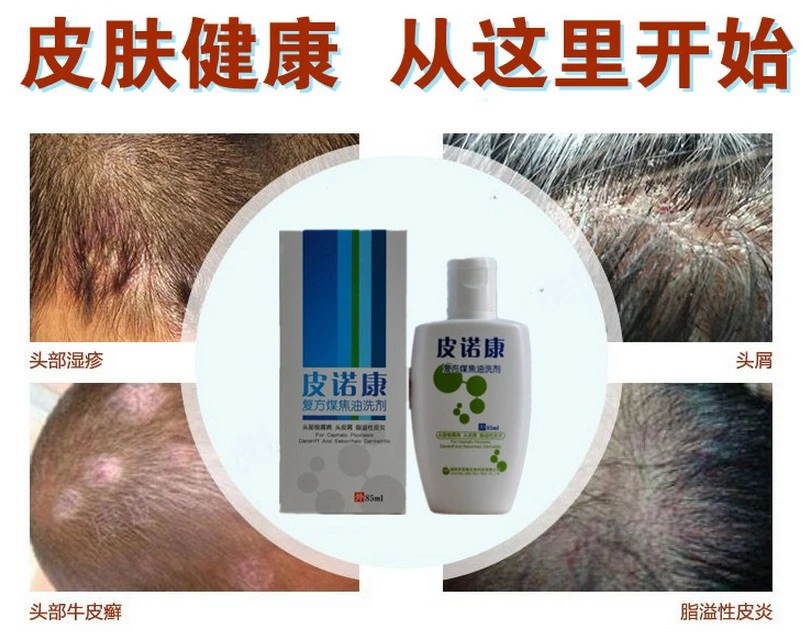 mg217 psoriasis shampoo ingredients hernia a pikkelysmr kezelsben