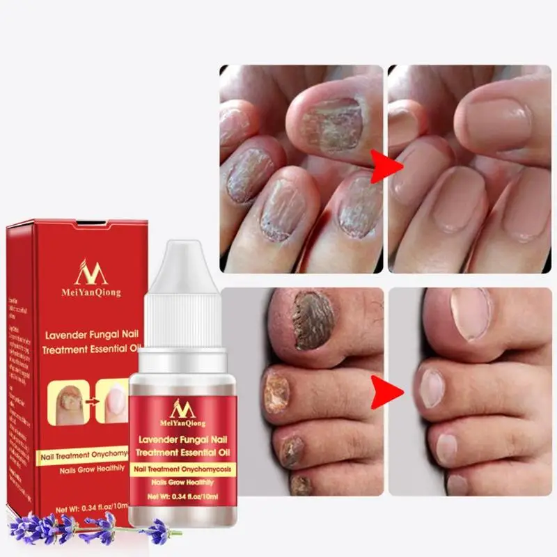 Nail Care Repair Oil Lavender Fungus Nail Treatment Essence Toe Nail