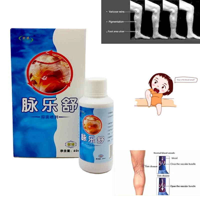 

3pcs Spider Varicose Veins Treatment Spray Itching Earthworm Lumps Bad Leg Cure Vasculitis Natural Solution Chinese Herb Spray