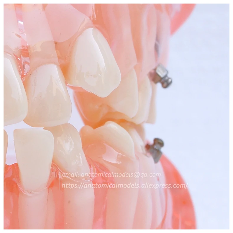 13022 DH202 Orthodontic Model 1 