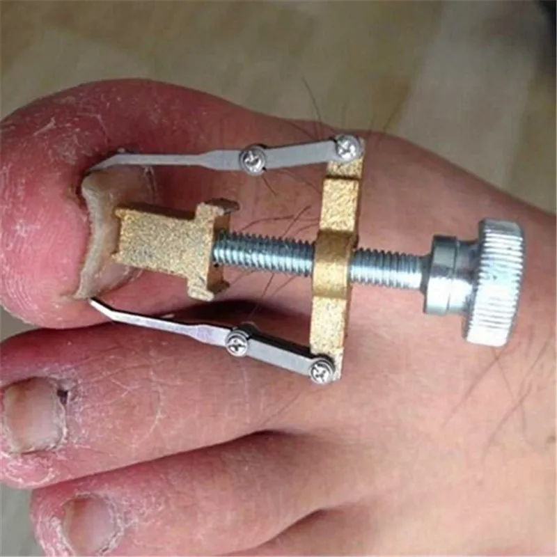 Вросших ногтей ног коррекции атлет Fixer восстановить педикюр инструмент с железный ящик