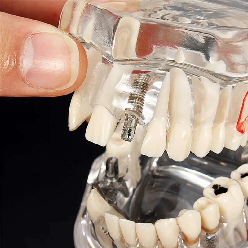 Стоматологический имплантат, модель зубов с реставрационным мостом, зубной Стоматолог для медицинских исследований