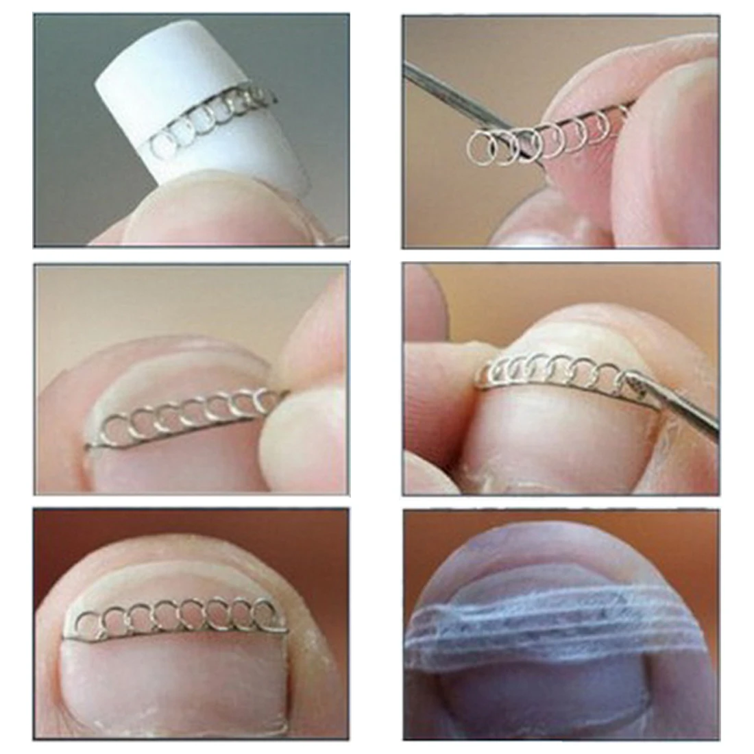 Acronyx Onyxis ortopédicos Pies Pie, herramientas para el cuidado de encarnada del clavo del dedo del pie pedicura corrección de fijador recuperar paroniquia 6 unids/caja Acronyx Onyxis ortopédicos Pies Pie, herramientas para el cuidado de encarnada del clavo del dedo del pie pedicura corrección de fijador recuperar paroniquia 6 unids/caja
