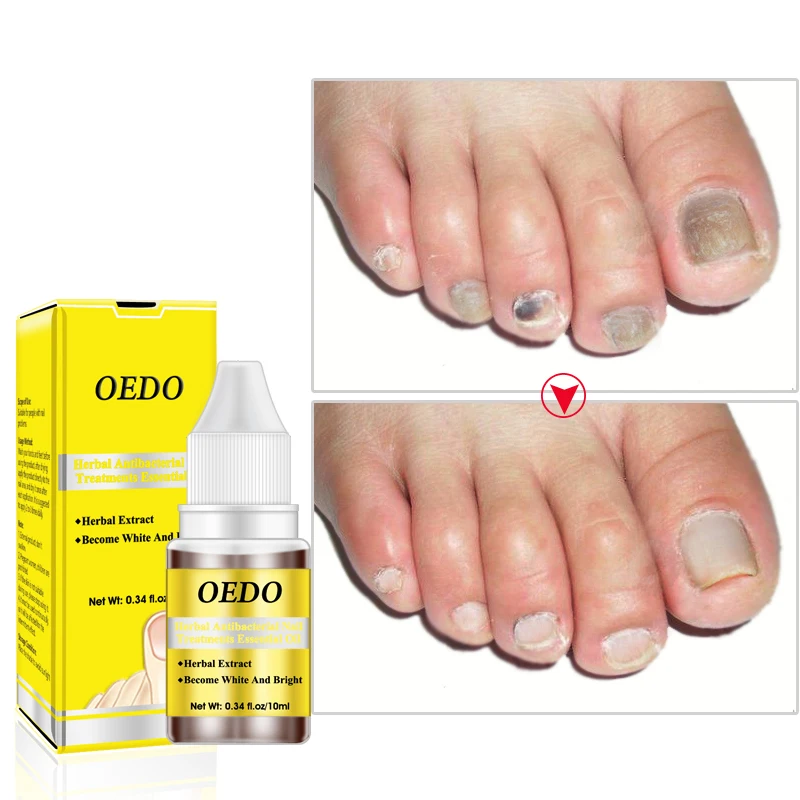 

OEDO 10ml Nail Treatment Essence Nail Oil Effective Moisturizing Fungus Removal Foot Care Liquid Spa Nail Care TSLM2
