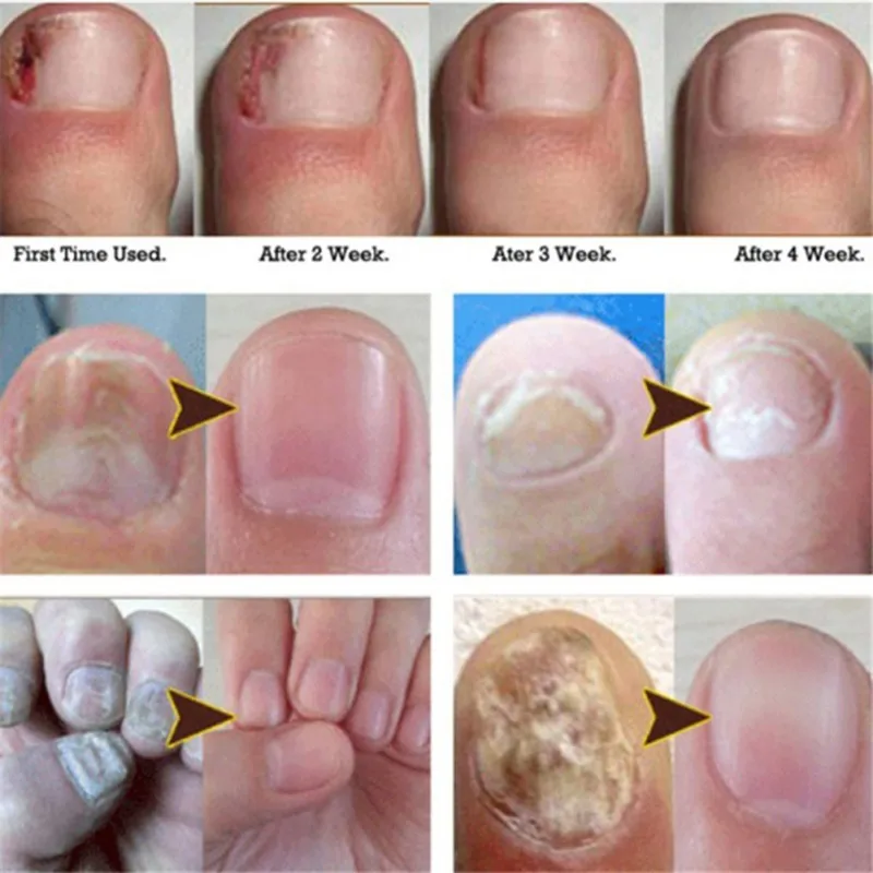 1 шт Лечение грибка ногтей против грибкового раствора для ногтей рингчервь чистый здоровый рост ногтей новейший