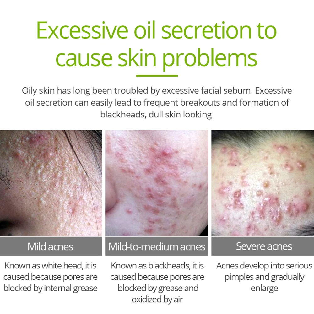 VIBRANT GLAMOUR Tea Tree Acne Eliminating Face Serum Remove Acne Scar Shrink Pores Oil Control Skin Care Whitening Moisturizing