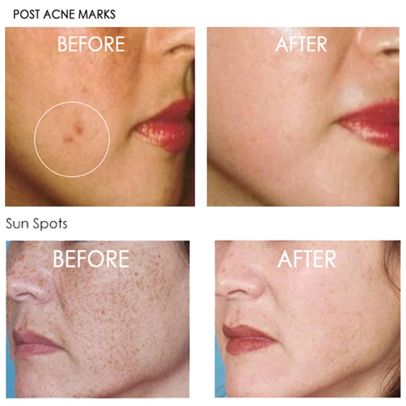 vitamin c for sun spots