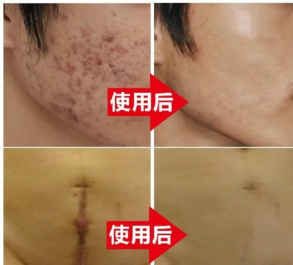 wound spot removal cream