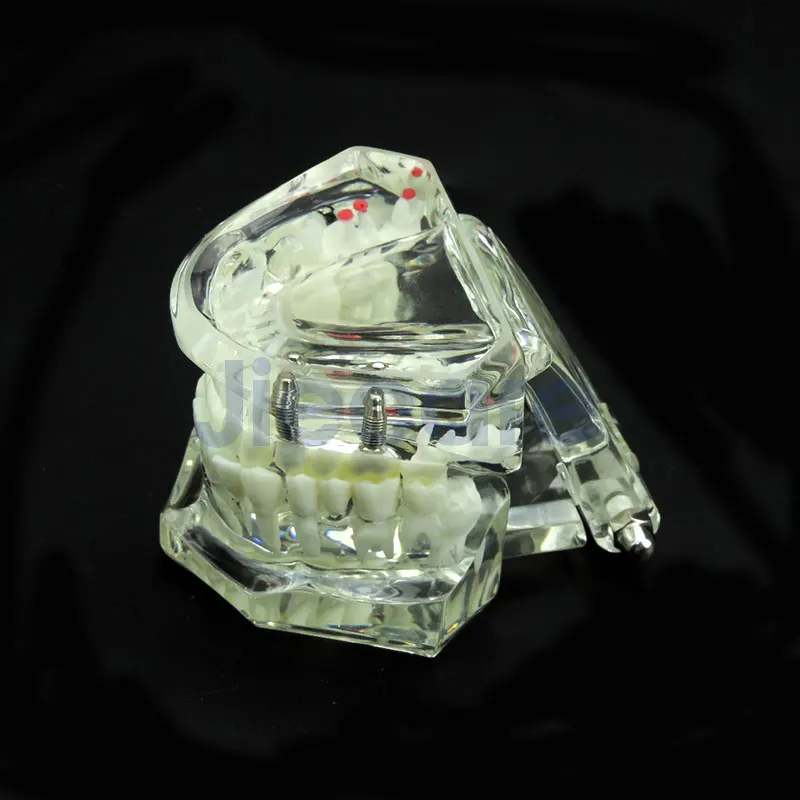 Dental Study Tooth Transparent Adult Pathological Teeth Model Fit for Adult Teaching Study