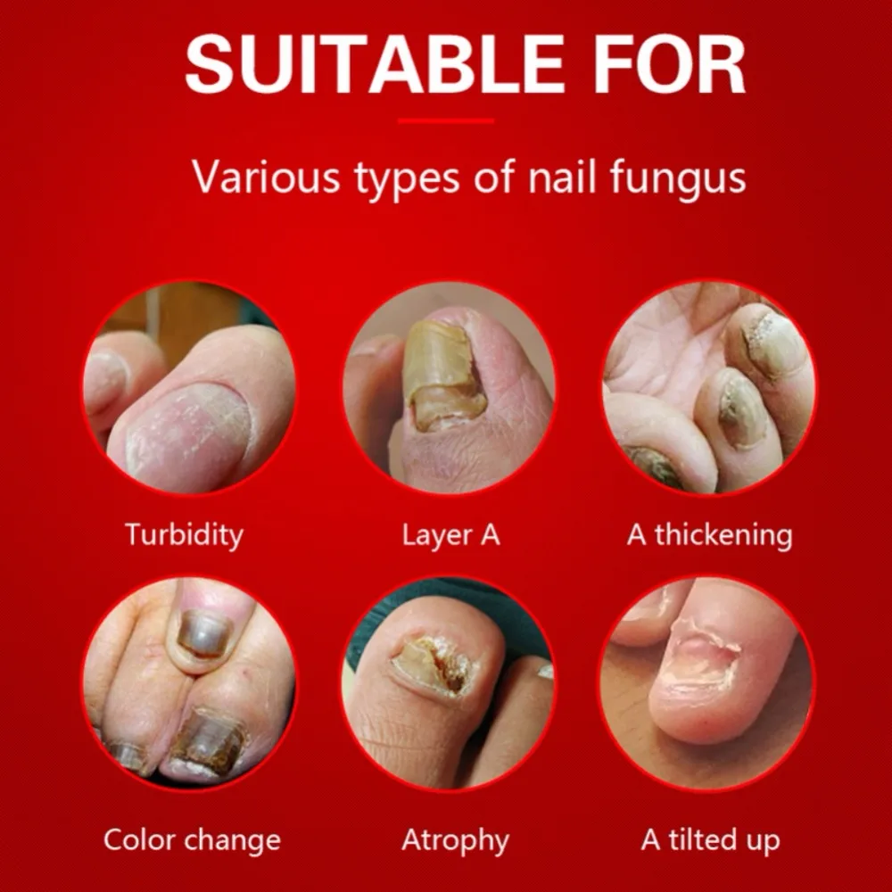 Лечение ногтей от грибка для ногтей и ногти на руках ноготь анти-грибка онихомикоз натирает для ногтей крем для ремонта ногтей