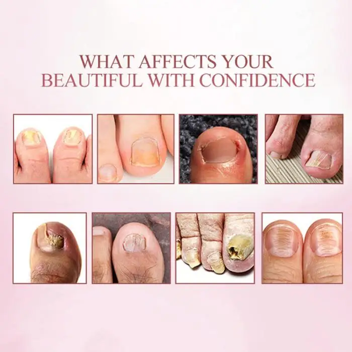 Nail Foot Protector Skin Care Cream Fungus Treatment Herb Nails Repair Liquid JIU55