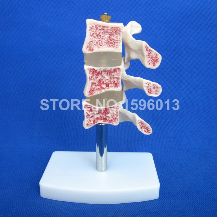 134 osteoporosis model (1)