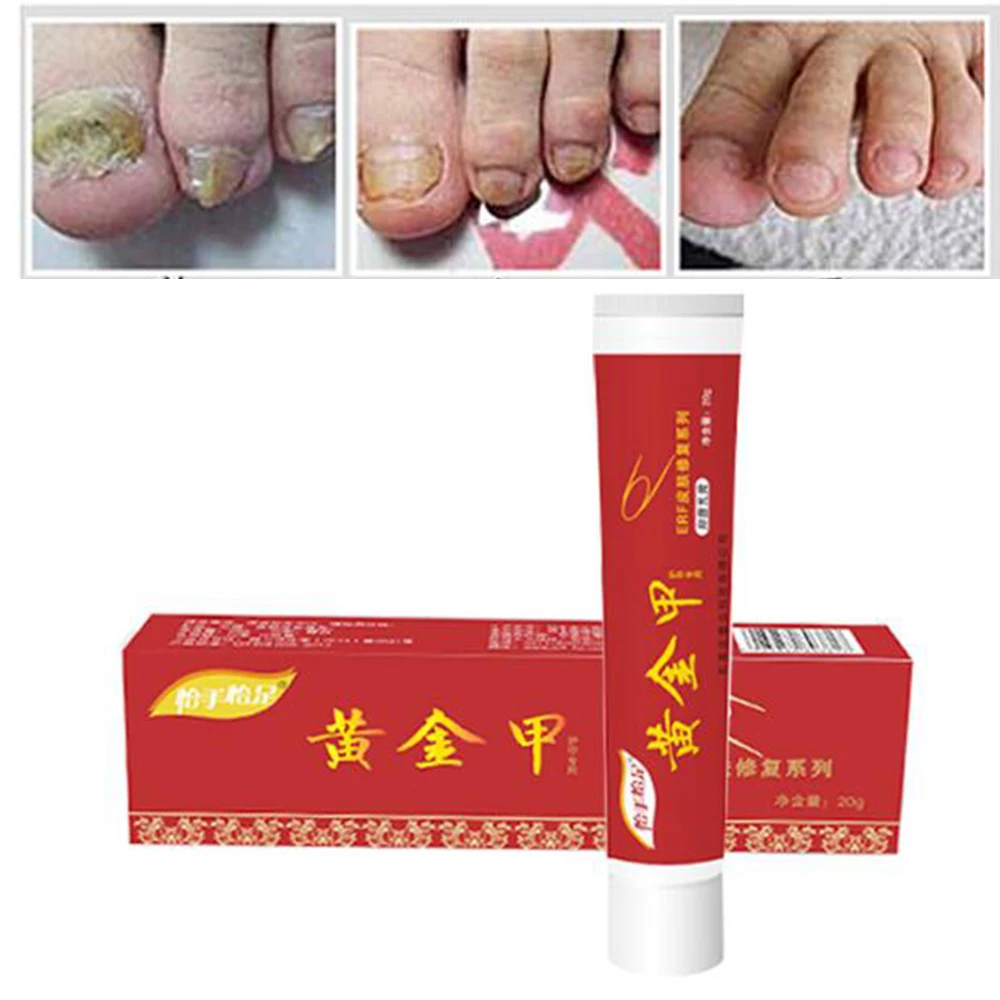 Китайская медицина Штукатурка для лечения грибка ногтей Крем онихомикоза против грибковой инфекции ногтей борется с бактериями естественно D043