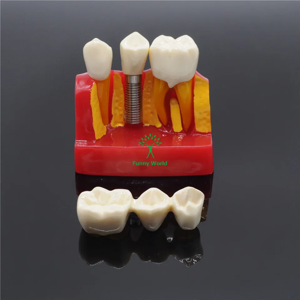 Dental Clinic Implant Analysis Crown Bridge Demonstration Teeth Model