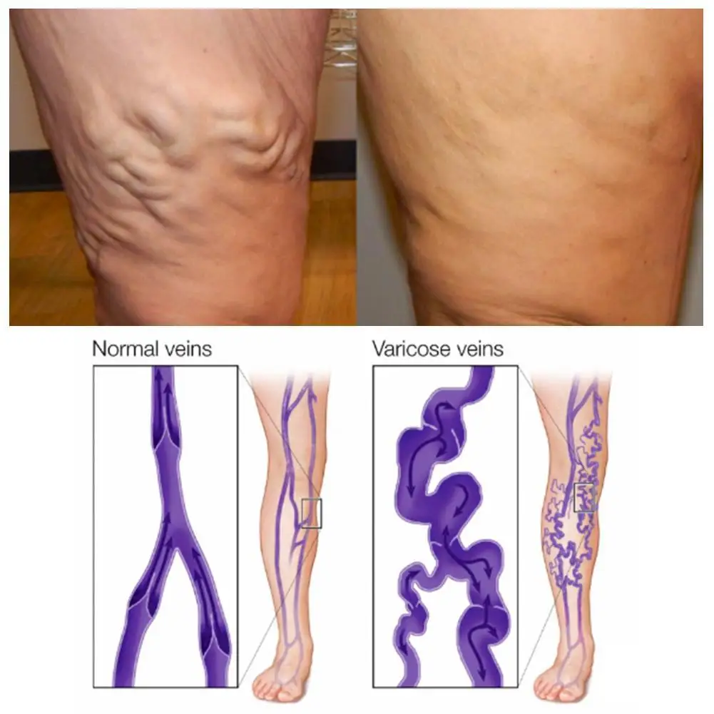1 шт варикозное расширение вен лечение васкулита флебита ангиит Мороз Нижние конечности воспаление кровеносный сосуд тухлые ноги крем