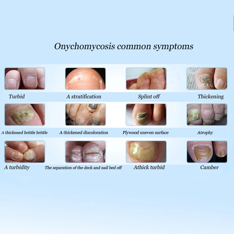 20 шт Paronychia лечение онихомикоза ногтей травы противогрибковое предотвращение инфекции грибок ногтей кутикулы смягчение корректор маникюр