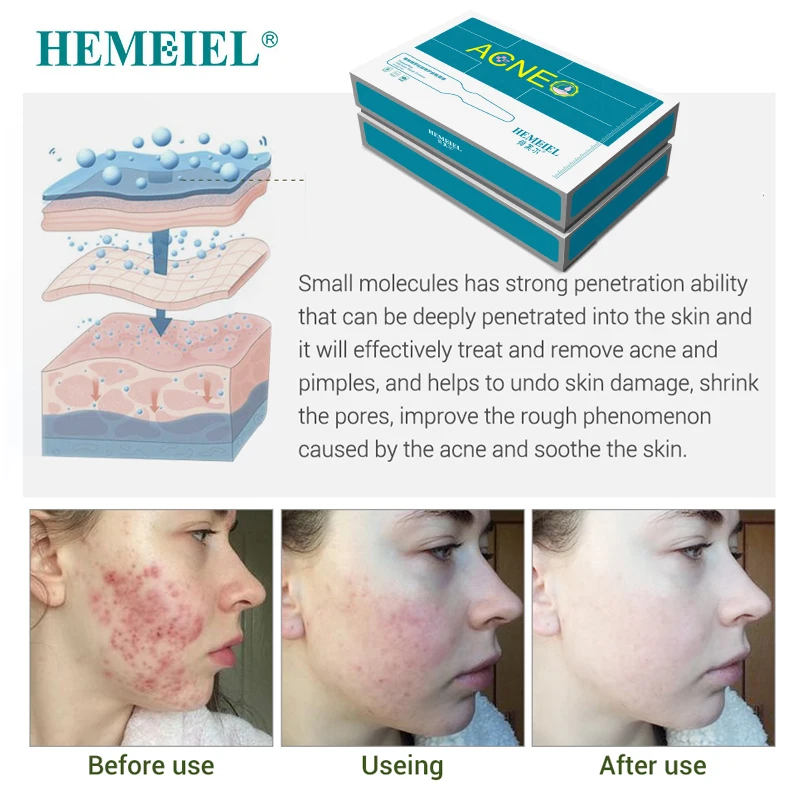 HEMEIEL Anti-Acne Serum Scar Removal Natural Essence Pimple Acne Treatment Repair Scars Facial Whitening Oil Control Skin Care