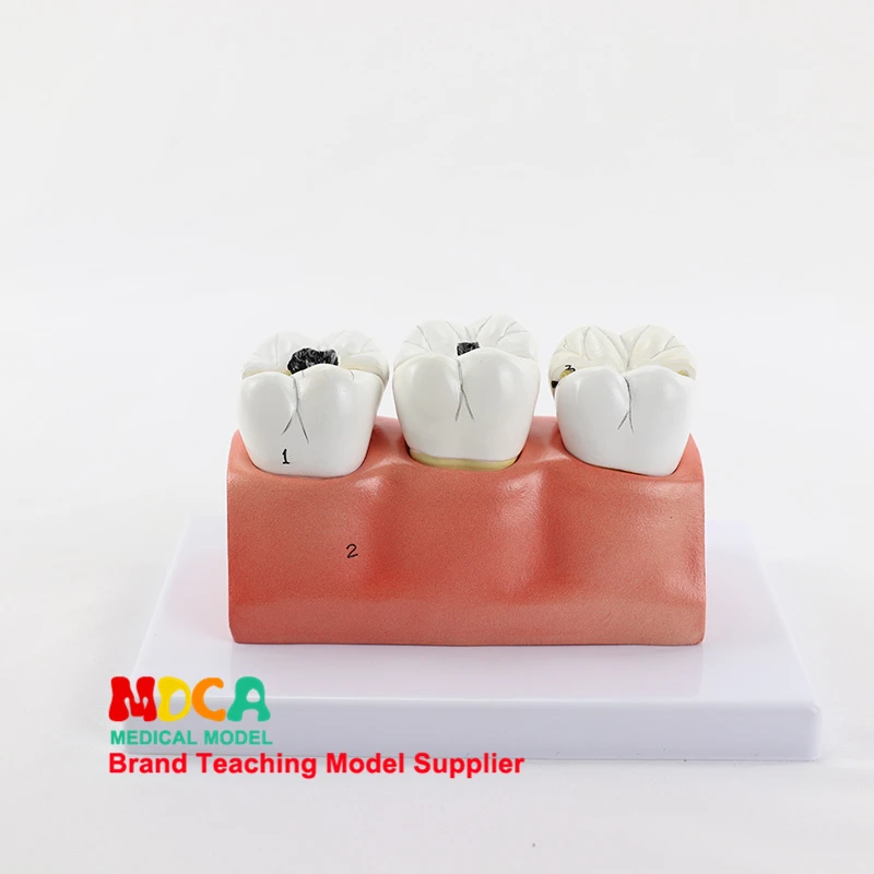 Кариеса разъемная модель стоматологии устные стоматологии дисплей медицинская модель обучения MYC008