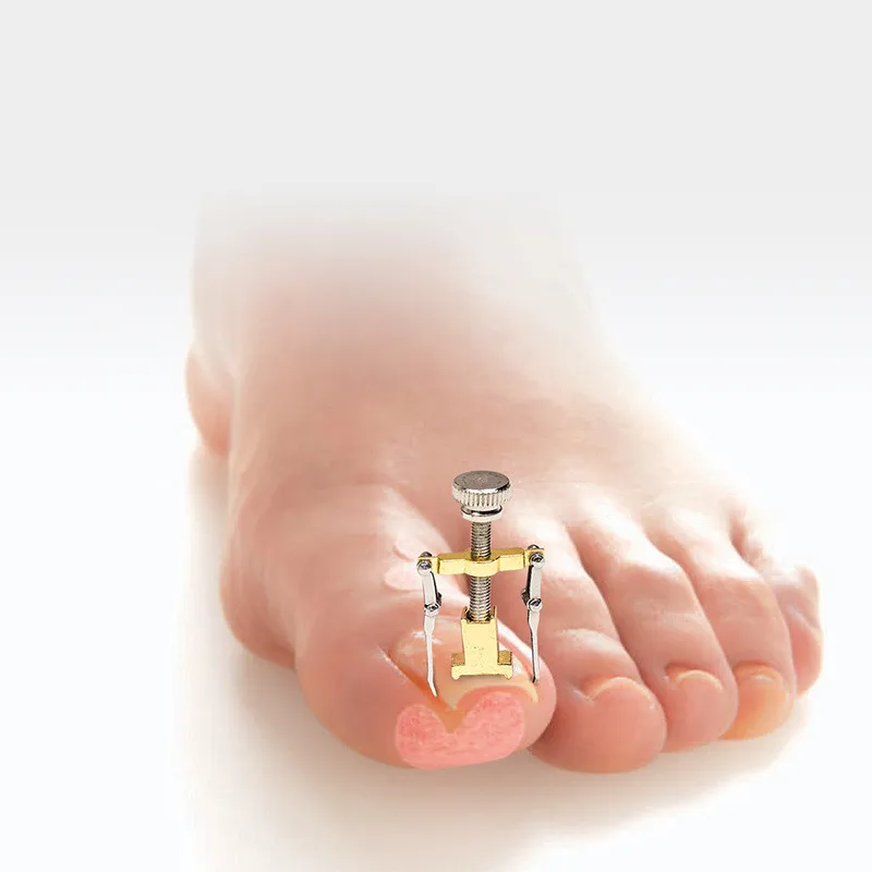 

ingrown toenails pedicure foot nail care tools file for feet orthotic acronyx ingrowing nail onyxis bunion corrector for toes