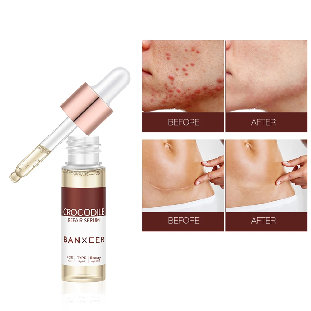 

Remove Acne Serum Crocodile Repair Scar Face Liquid Essence Skin Care Whitening for Spots Acne Treatment Stretch Marks