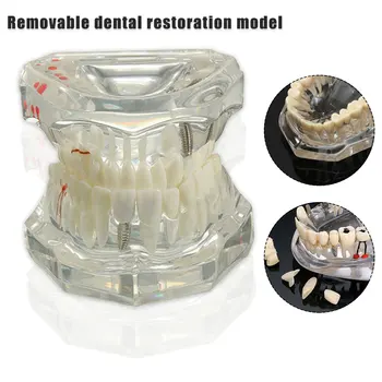 

Dental implant model active tooth model pathological tooth model 1pc detachable oral repair model tooth model
