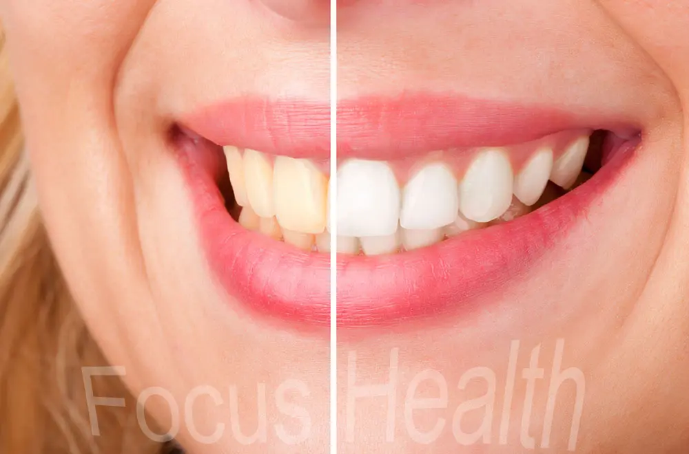 14 Pouches 28 Strips 3D Teeth Whitening Strips Bleach Bright White Dental Bleaching Veneers Tooth Whitener Oral Hygiene Care Before And After