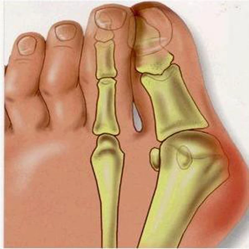 2 шт. = 1 пара ортопедические стельки для ухода за ногами, Мягкий корректор, разделитель пальцев ног, система для медицинского педикюра, коррекция вальгусной деформации