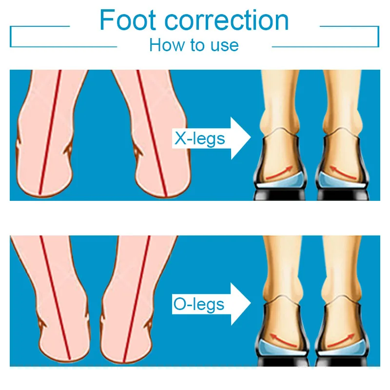 Soumit гель O/X тип ноги ортопедические стельки внутри снаружи ноги коррекции ортопедические пятки поддержка Вставки колодки для мужчин женщин