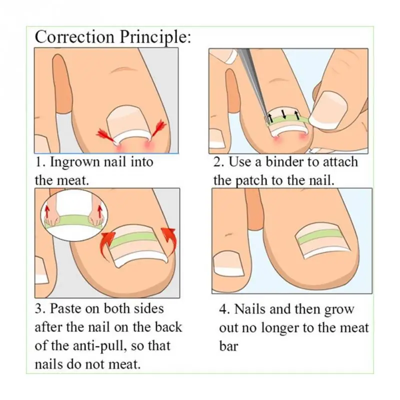 4 мм 12/24 шт. Профессиональный коррекция ногтей Стикеры патч, ухаживает за кожей стоп коррекция паронихии файл эластичная заплатка корректор обработки