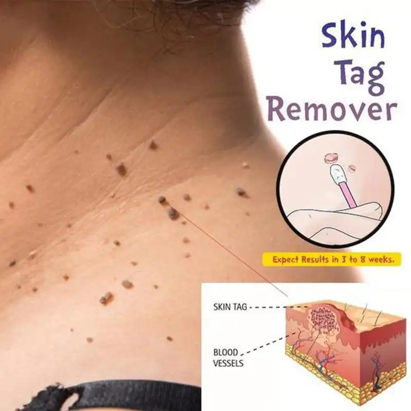 warts treatment on neck