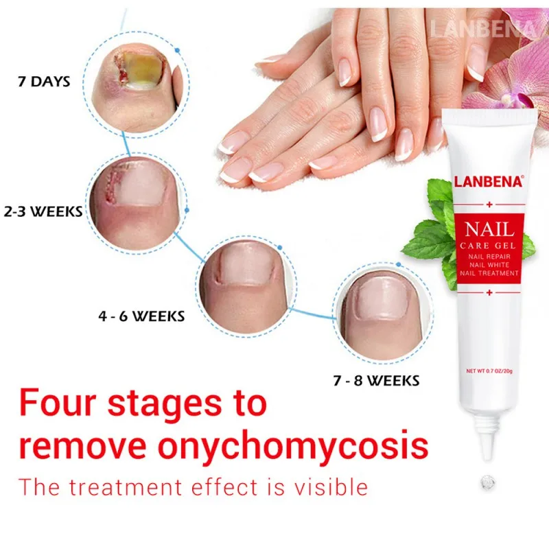 Effective Onychomycosis Paronychia Fungus Infection Repair Solution Gel Fingernails Toenails Care Nail Treatment Pen
