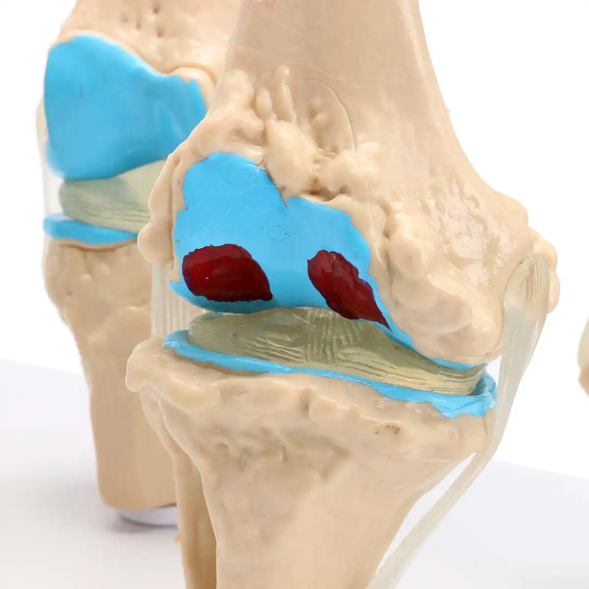 1 компл. Съемная Скелет коленного сустава анатомическая модель остеопороз Morbid состояние модели обучение медицине поставки