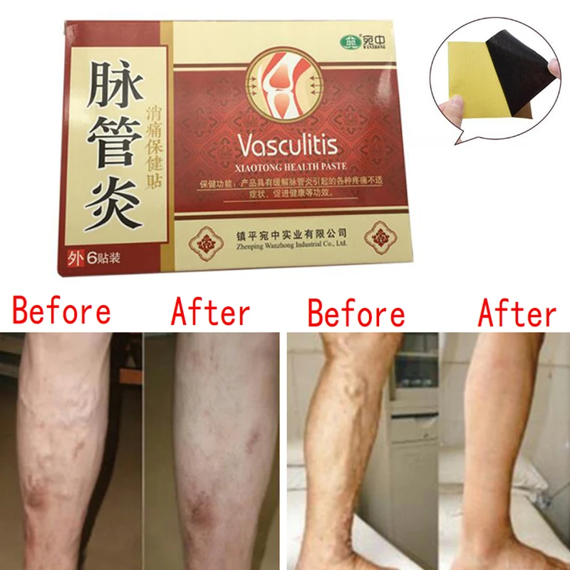 

24 Pcs Spider Veins Varicose Treatment Plaster Varicose Veins Cure Patch Vasculitis Natural Solution Herbal Patches