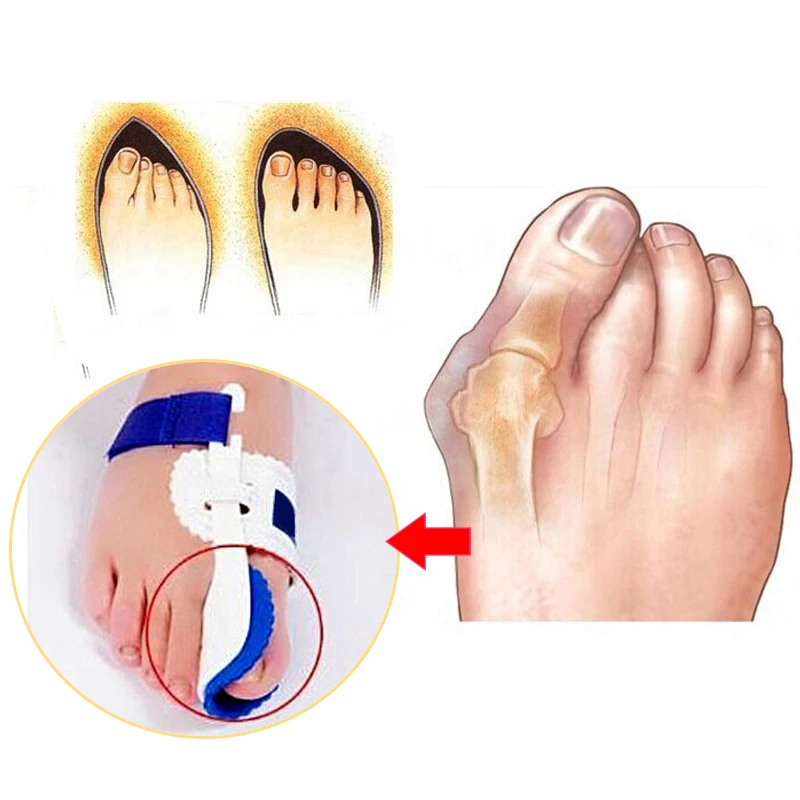 Foot Thumb Corrector Of The Toe Orthotics Bunion Corrector Splint Toe Straightener Foot Pain Relief Hallux Valgus Pedicure Tools