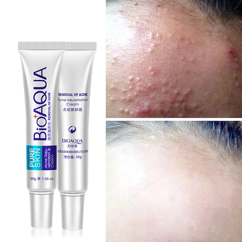 BIOAQUA Acne Cream anti Acne moisturizing anti wrinkle Face Acne