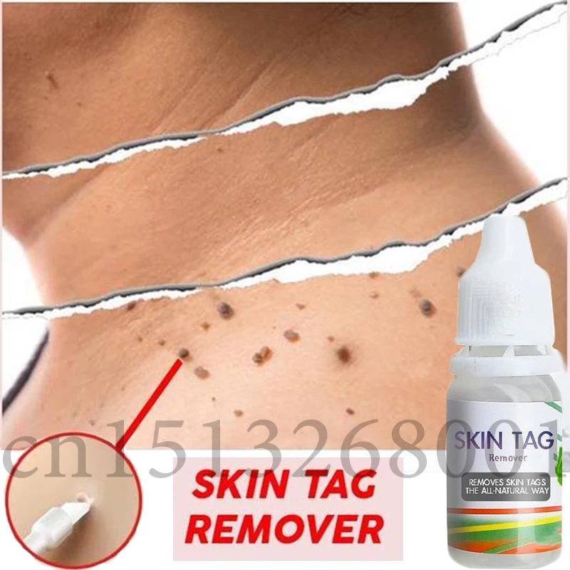 Skin Tag Remover 12 hours Tu kill Medical Tu kill Remover Skin Tag Mole & Genital Wart Remover Dropshipping