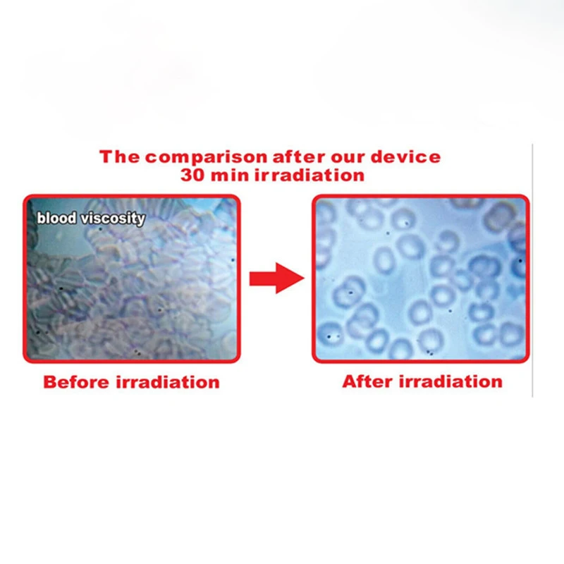 

infrared Physical Therapy Soft Tissue Repaired Tinnitus Laser Watch Treatment Low Lever Laser Light Laser Therapy Equipment