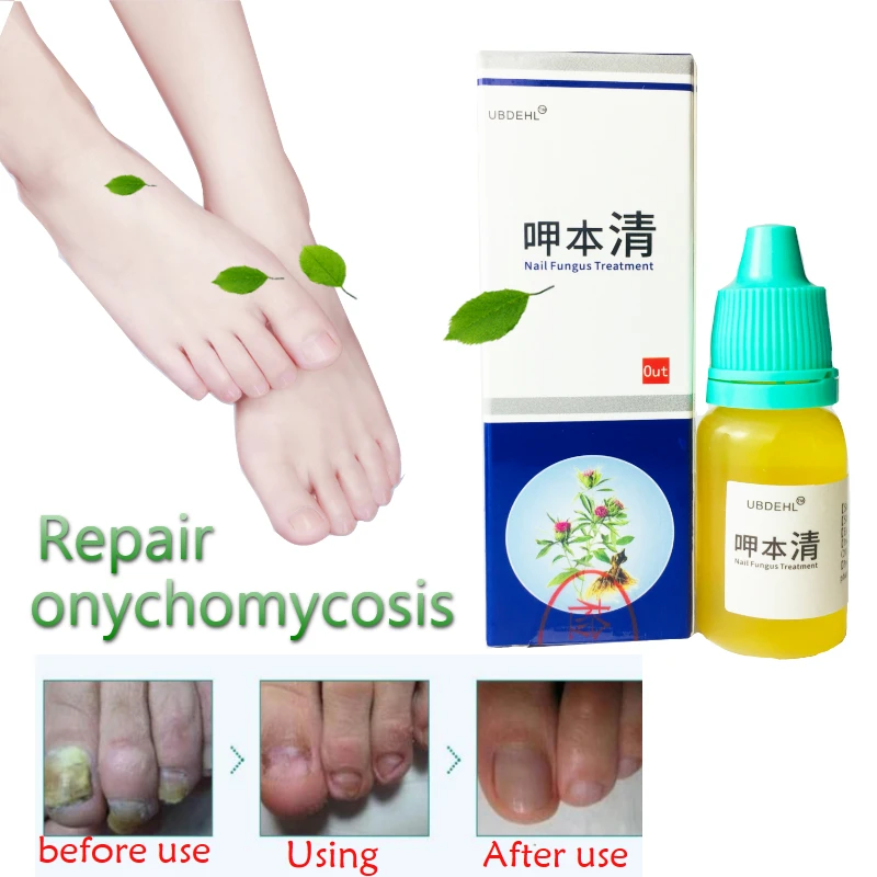 

10ml Nail Treatment Onychomycosis Paronychia Anti Fungal Nail Infection Good Result Chinese Herbal Toe Nail Fungus Treatment