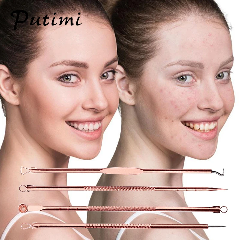 Putimi 4 шт./компл. розовое золото для удаления угрей акне иглы экстрактор прыщей