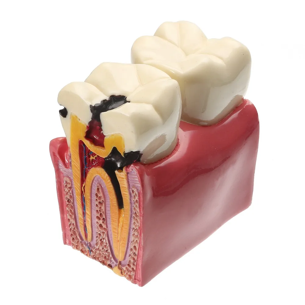 

NEW 1PCS 6X Denture Teeth Model Caries Comparison Model Tooth Decay Model Dentist Pathologies For Medical Science Teaching