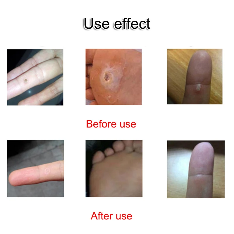 

6 Pcs Exfoliating Corn Foot Patch Feet Dead Skin Remove Treatment Foot Plantar Warts Calluses Away RJ99