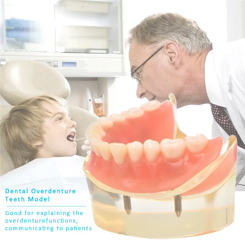 Mandibulares com Implante de Dente Modelo Teeth Dental Overdenture Removível Interior Mandibular Inferior Estudo Ensino Modelo Dentes 15 Dentes dentários dentários modelo interior removível mandibular