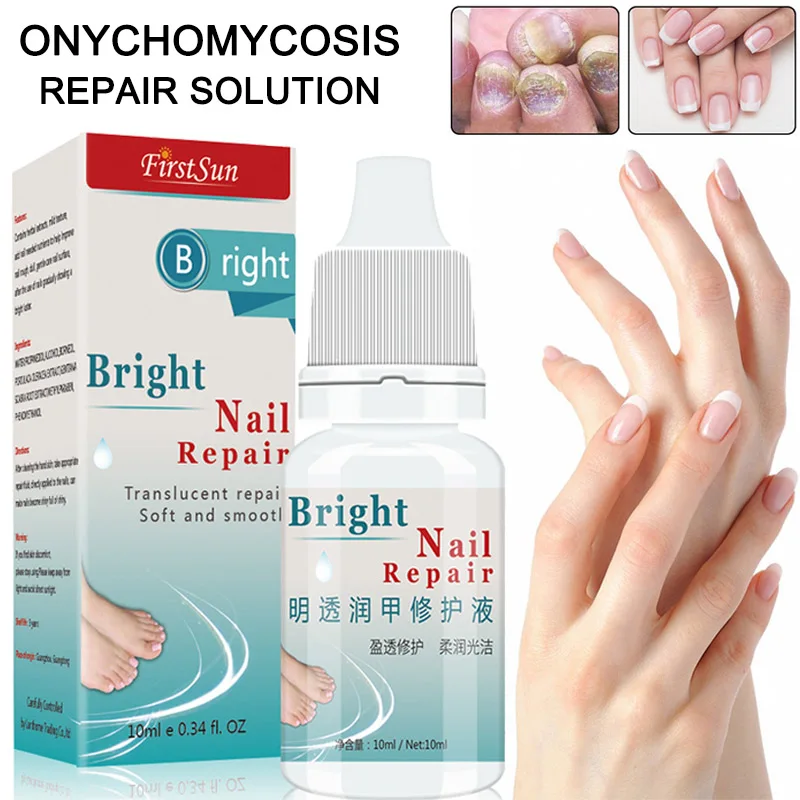 High Quality 10ml Nail Fungal Treatment Anti Fungus Onychomycosis Removal Toenail Care Nails Repair Liquid High Quality 10ml Nail Fungal Treatment Anti Fungus Onychomycosis Removal Toenail Care Nails Repair Liquid
