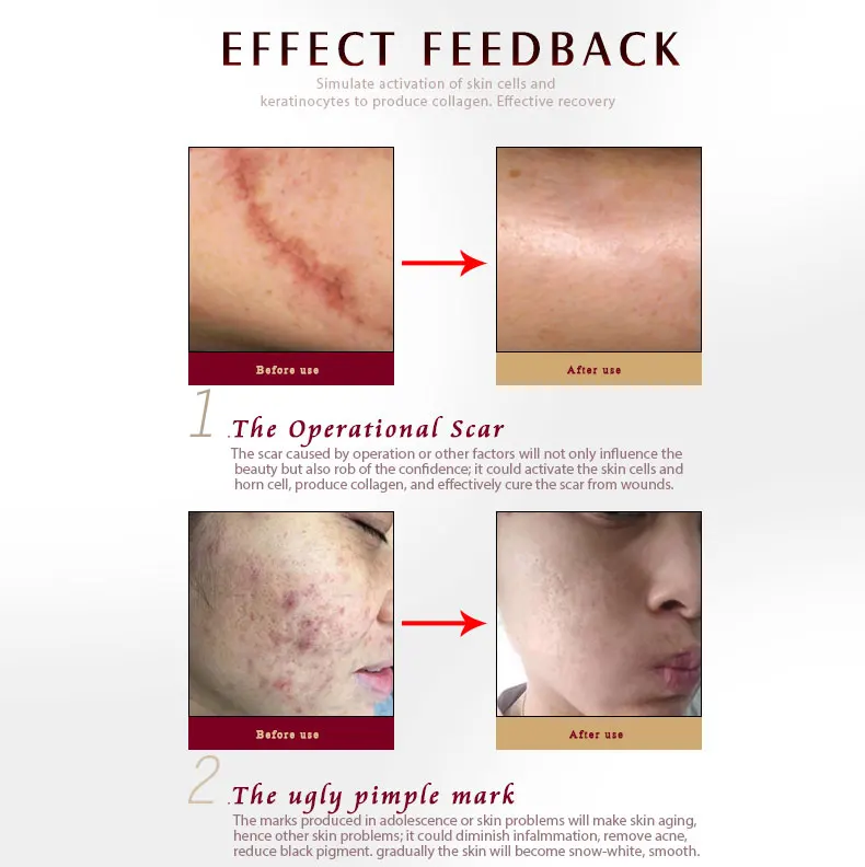 scar-ance-removal-gel_08