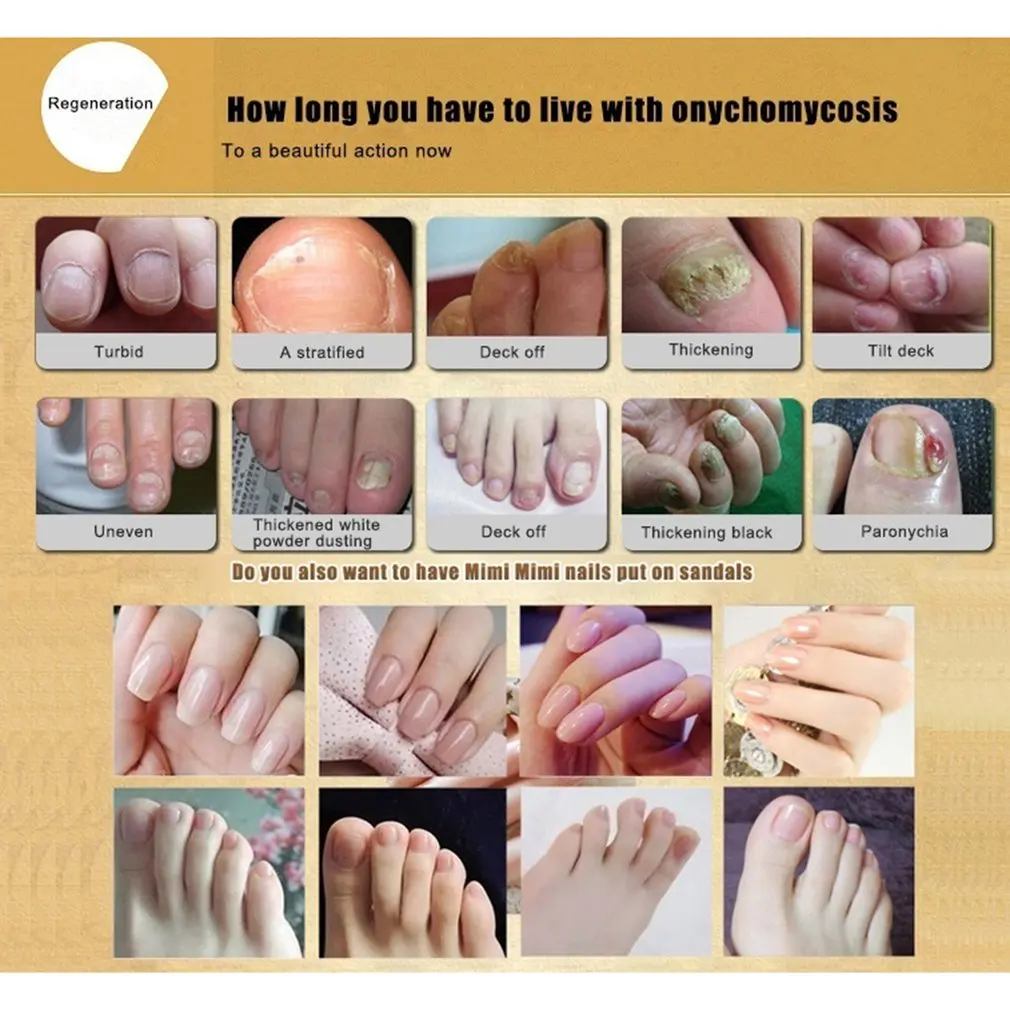 30ml Fungal Nail Treatment Essence Nail And Foot Whitening Toe Nail Fungus Removal Feet Care Nail Essence 30ml Fungal Nail Treatment Essence Nail And Foot Whitening Toe Nail Fungus Removal Feet Care Nail Essence