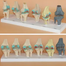 

Knee Joint Pathological changes model Disease process Knee lesion model 6pcs set free shipping