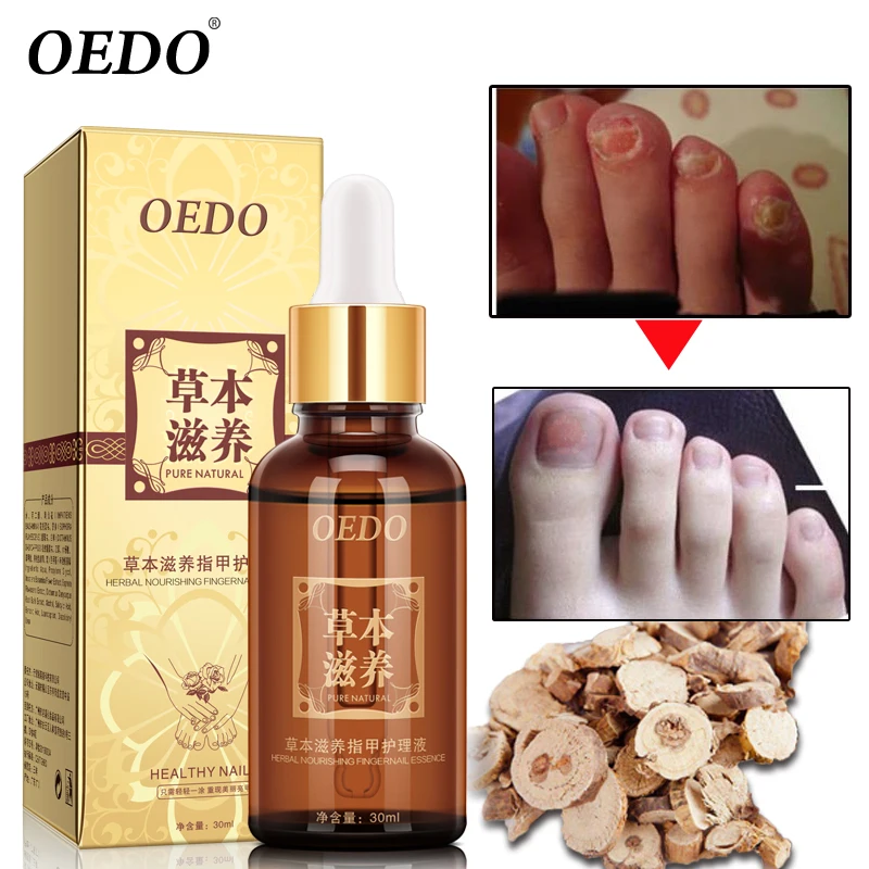 

OEDO Nail Treatment Essential oil Hand and Foot Onychomycosis Toe Nail Fungus Removal Infection Feet Care 30ml
