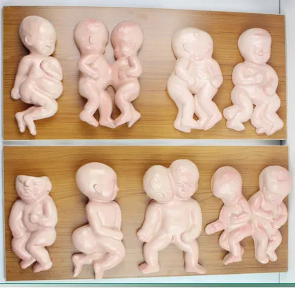

Malformation model abortion fetus demography